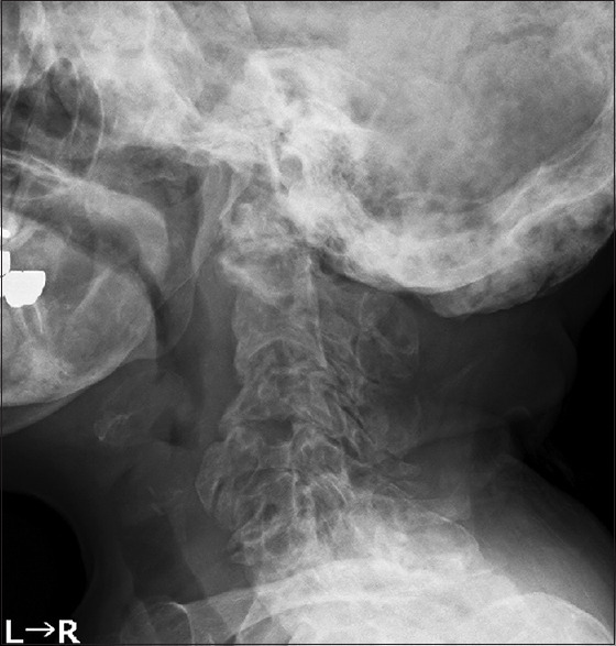 Navigation-assisted occipitocervical fixation and decompression in a patient with polyostotic fibrous dysplasia.