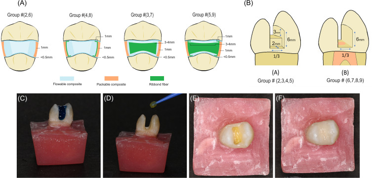 Effect of Fiber-Reinforced Composite Placement Site on Fracture Resistance of Premolar Teeth: An in vitro Study.