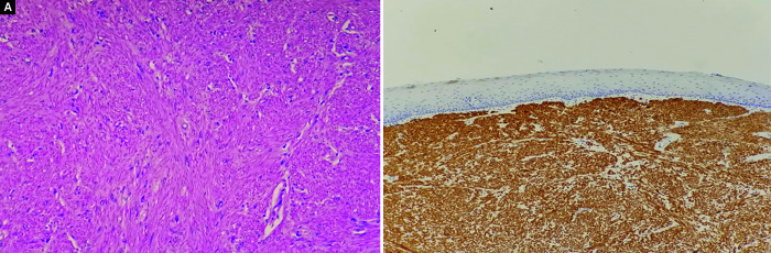 A Rare Case of Dysphagia: A Case Report.