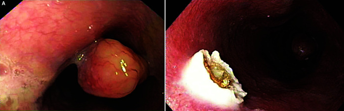 A Rare Case of Dysphagia: A Case Report.