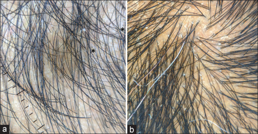 Moth-eaten alopecia and beyond: Syphilitic alopecia - Revisited.
