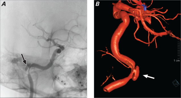 Spontaneous Right Intrapetrous Internal Carotid Dissection in a Patient With Active COVID-19.