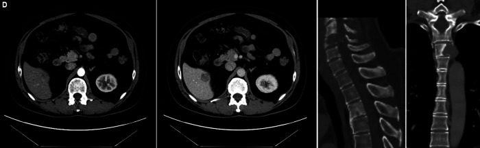 Complete Response with Immunotherapy Alone after Discontinuing VEGF Inhibitor in Advanced Hepatocellular Carcinoma: A Case Report.