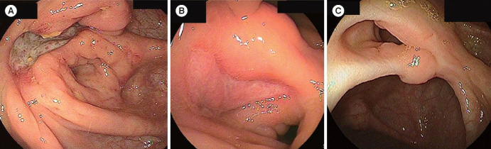Intestinal ultrasound for intestinal Behçet disease reflects endoscopic activity and histopathological findings.