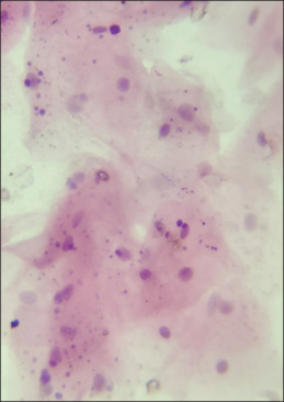 Comparative study of conventional exfoliative cytology and centrifuged liquid-based cytology in oral leukoplakia and oral squamous cell carcinoma patients.