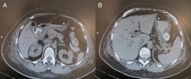 Double EUS-guided bypass for gastric outlet and biliary tract malignant obstruction: A standardized one-step approach (with videos).