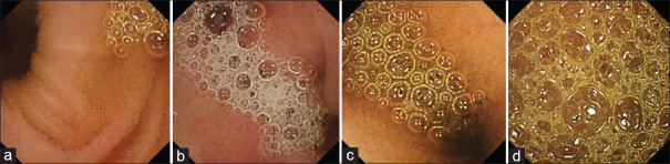 Identification of Circular Patterns in Capsule Endoscopy Bubble Frames.