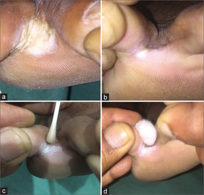 Therapeutic pearl: A simple cost-effective treatment for chronic digital intertrigo of toes.