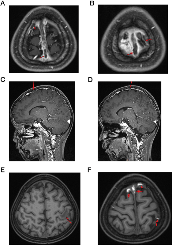 Recurrent Cerebral Venous Sinus Thrombosis Occurred in an Acute Lymphoblastic Leukemia Child with Mutated Lipoprotein Lipase Gene during Asparaginase Therapy.