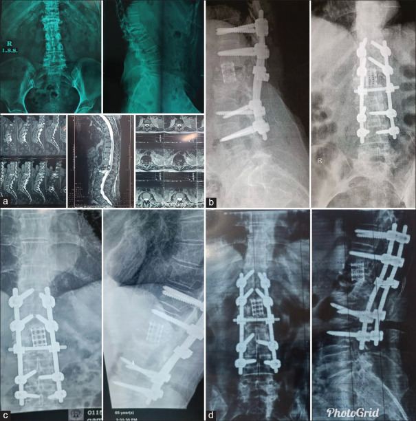 Short-term assessment of functional outcomes and quality of life after thoracic and lumbar spinal metastasis surgery.