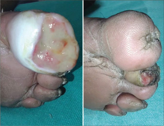 Platelet-rich fibrin therapy in the management of nonhealing trophic ulcers due to underlying leprous neuropathy.