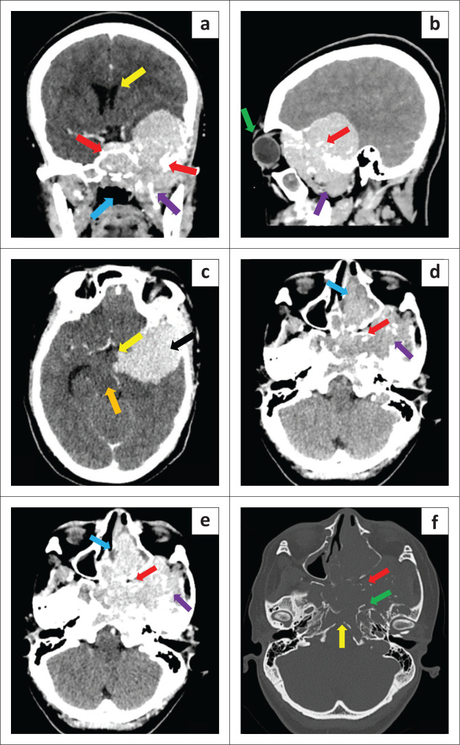 Multiple myeloma in a young female presenting as an aggressive skull-base tumour.