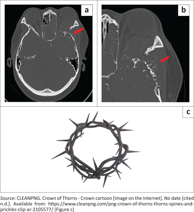 Multiple myeloma in a young female presenting as an aggressive skull-base tumour.