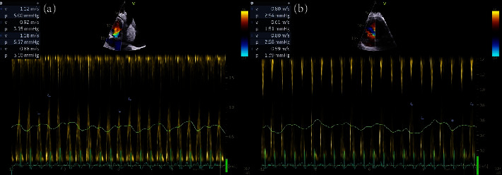 Hodgkin Lymphoma Presenting as Cardiac Tamponade in a Young Female.