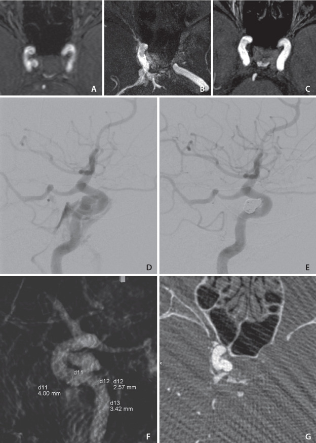 Successful Embolization of a Direct Carotid Cavernous Fistula under Gadolinium-Based Angiography.