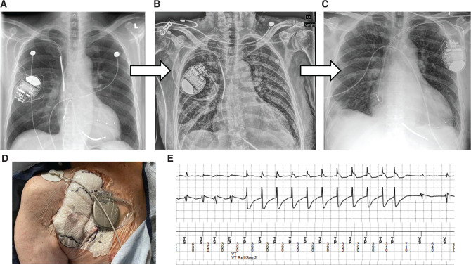 Utility of an Externalized Temporary Transvenous Implantable Cardioverter-defibrillator System in the Setting of Ventricular Tachycardia Storm and Concurrent Device Infection Requiring Extraction.