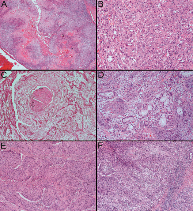 Epidemiological and Histopathological Features of Oral Squamous Cell Carcinoma-A Retrospective Study.