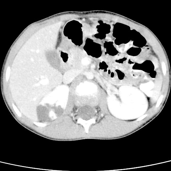 The First Pediatric Case of an IFT140 Heterozygous Deletion Causing Autosomal Dominant Polycystic Kidney Disease: Case Report.