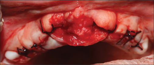 Negligence of gingival overgrowth leading to loss of entire dentition.