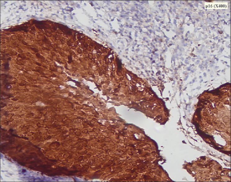 Unusual Extension of Superficial Spreading Squamous Cell Carcinoma of Cervix to Uterus, Paraovarian, Paratubal Tissue, and Vaginal Surface: A Unique Case Report.