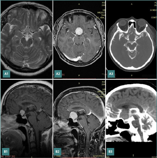 The impact of arachnoid structures on skull-base meningioma surgical management: a radiological analysis and narrative review.