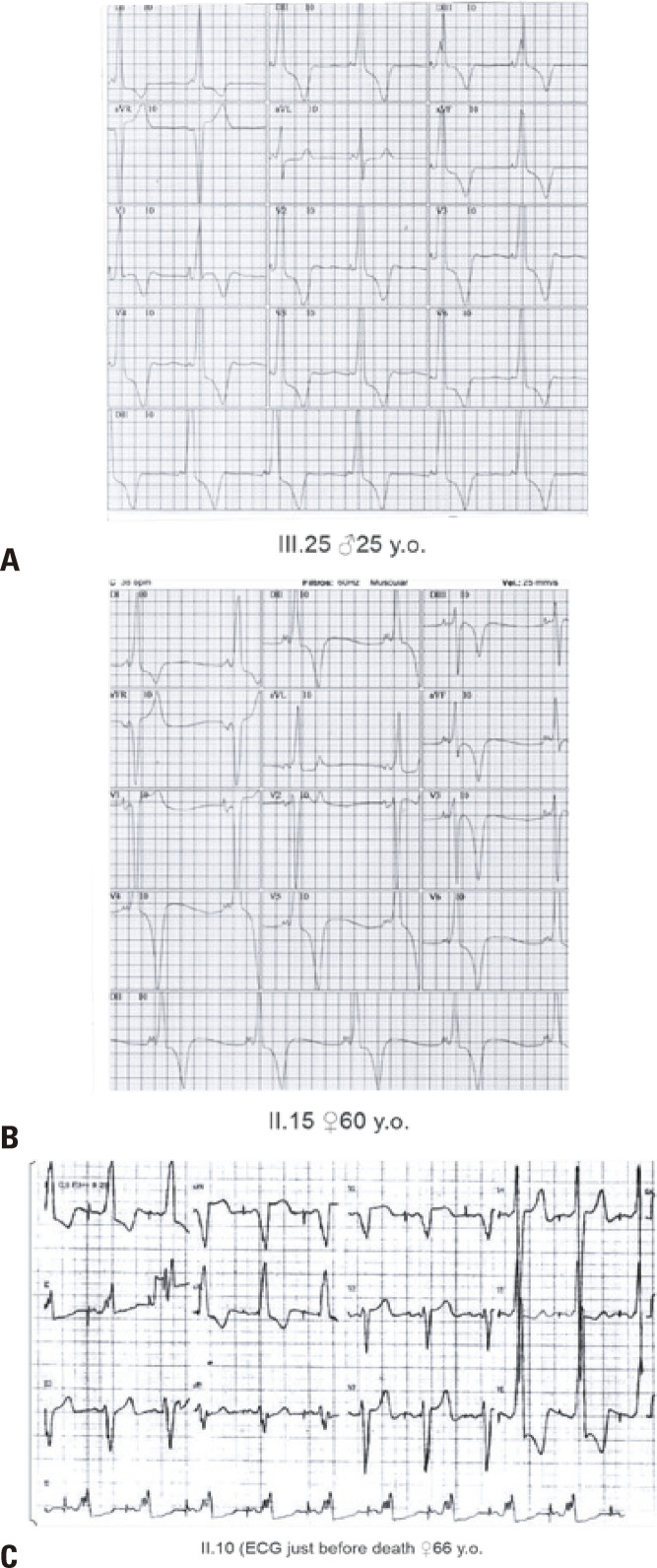 PRKAG2 syndrome, a rare hypertrophic cardiomyopathy: a Brazilian long-term follow-up with extracardiac disorders.