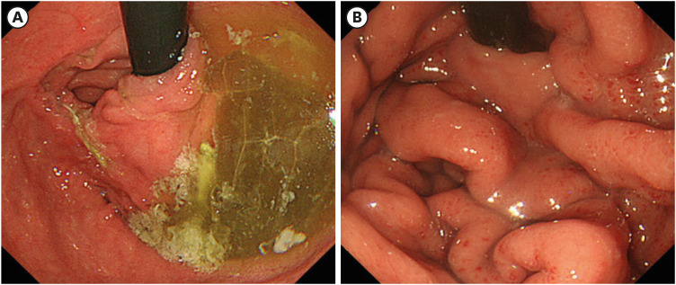 Characteristics of Metachronous Remnant Gastric Cancer After Proximal Gastrectomy: A Retrospective Analysis.