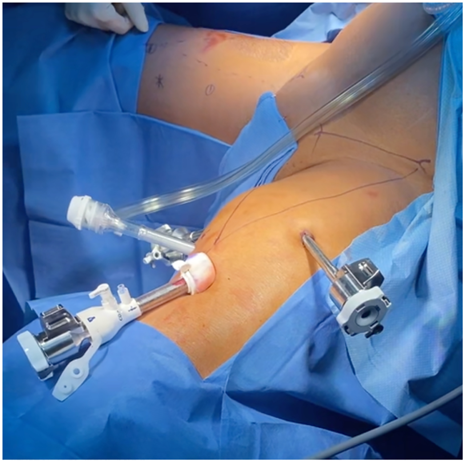 Video-endoscopic inguinal lymphadenectomy (VEIL) oncological and surgical benefits compared to open inguinal lymph node dissection (ILND).
