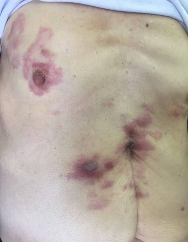 Cutaneous Metastases of Signet-Ring Cell Gastric Carcinoma: A Case Report.
