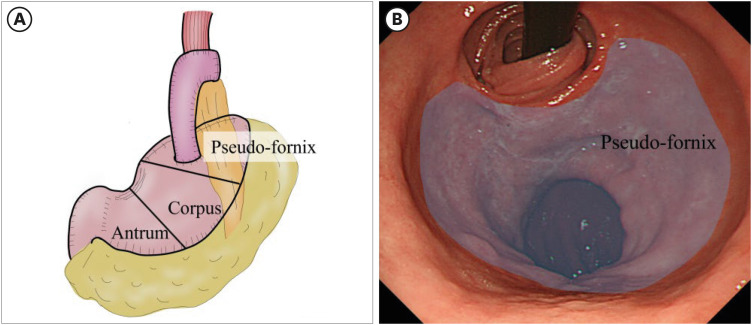 Characteristics of Metachronous Remnant Gastric Cancer After Proximal Gastrectomy: A Retrospective Analysis.
