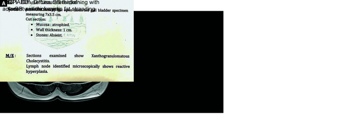 Thick-walled Gallbladder: A Pragmatic Management Approach.