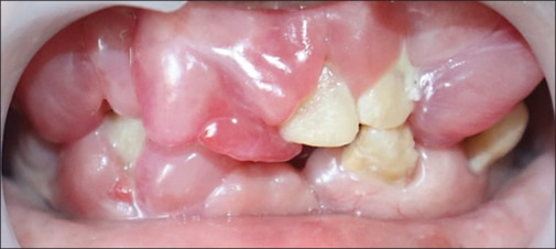 Negligence of gingival overgrowth leading to loss of entire dentition.