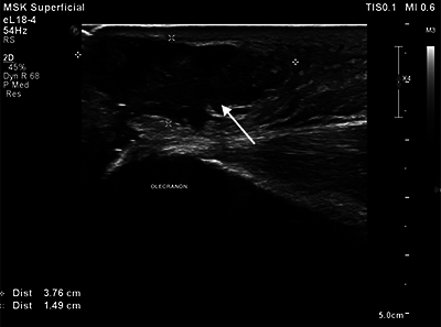 A Case of a Mirror Image Artifact in the Forearm.