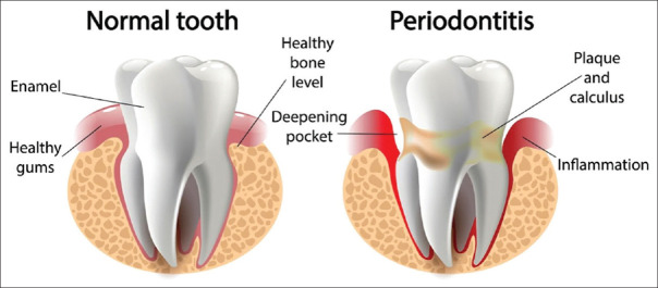 Menopause and Oral Health: Clinical Implications and Preventive Strategies.