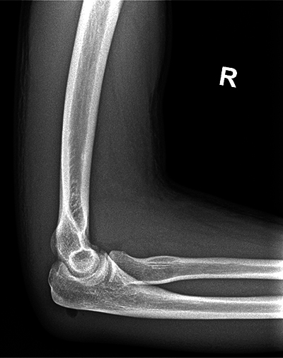 A Case of a Mirror Image Artifact in the Forearm.