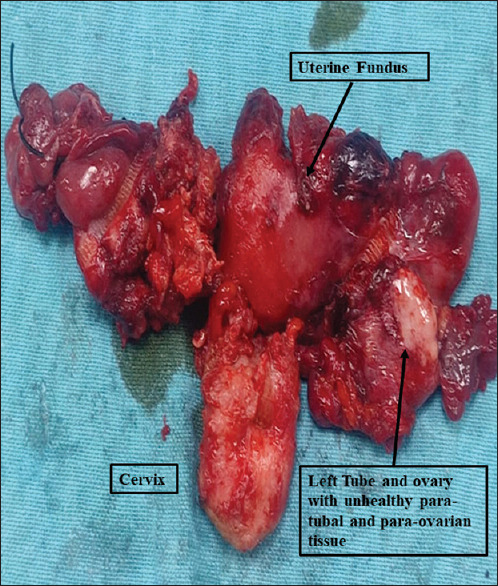 Unusual Extension of Superficial Spreading Squamous Cell Carcinoma of Cervix to Uterus, Paraovarian, Paratubal Tissue, and Vaginal Surface: A Unique Case Report.