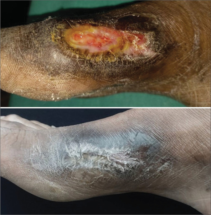 Platelet-rich fibrin therapy in the management of nonhealing trophic ulcers due to underlying leprous neuropathy.