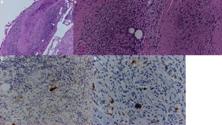 Hodgkin Lymphoma Presenting as Cardiac Tamponade in a Young Female.
