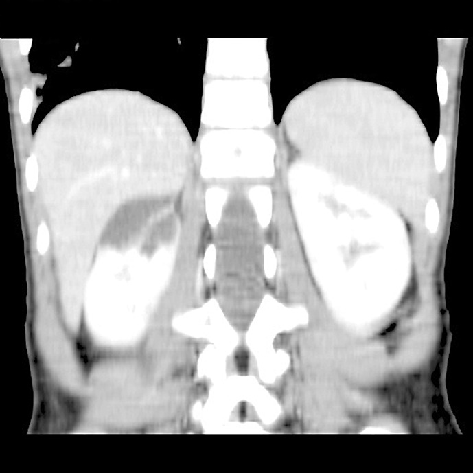 The First Pediatric Case of an IFT140 Heterozygous Deletion Causing Autosomal Dominant Polycystic Kidney Disease: Case Report.