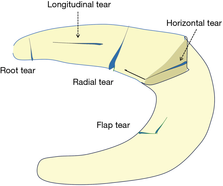 All-inside suture meniscal repair using suture passer.