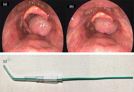 Alternative Hybrid Technique of Intubation Using C-MAC and Yankauer Suction Catheter: Case of A Floppy Supraglottic Mass.