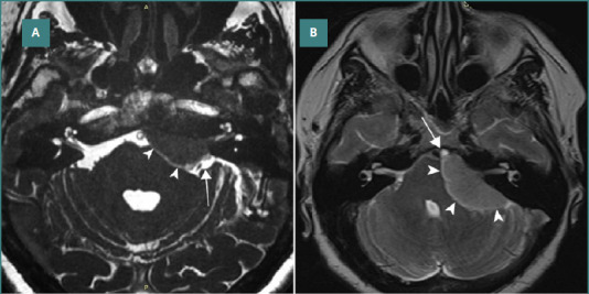 The impact of arachnoid structures on skull-base meningioma surgical management: a radiological analysis and narrative review.