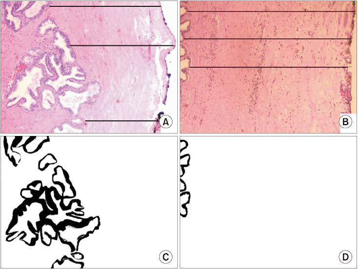 Computerized metric assessment of glandular tissue volume within the peripheral zone of the prostate using combined magnetic resonance imaging and histopathology: Possible pathophysiological implications on prostate cancer development.