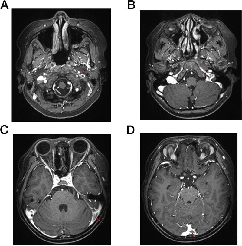 Recurrent Cerebral Venous Sinus Thrombosis Occurred in an Acute Lymphoblastic Leukemia Child with Mutated Lipoprotein Lipase Gene during Asparaginase Therapy.