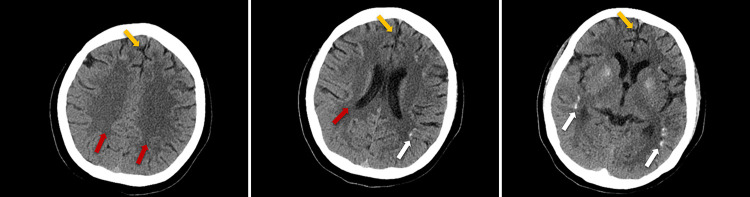 Neurosyphilis Presenting as Psychiatric Symptoms at Younger Age: A Case Report.