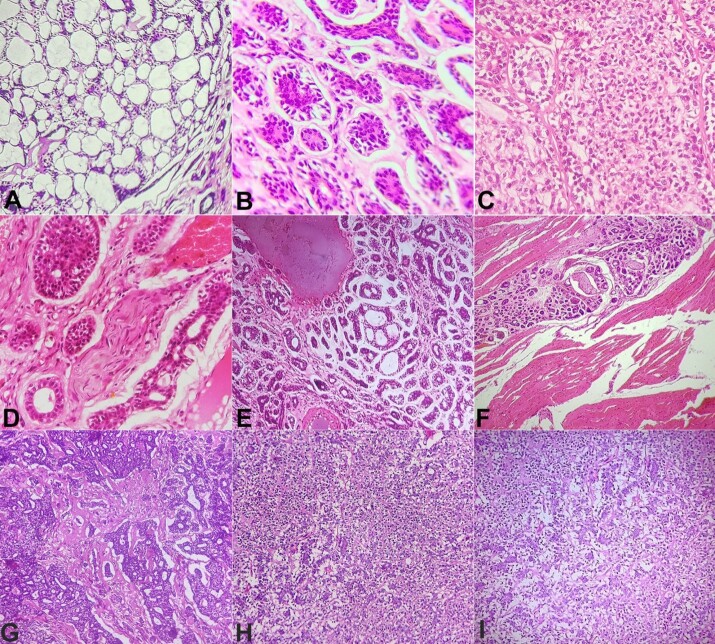 Submandibular and sublingual salivary gland involvement in adenoid cystic carcinoma.