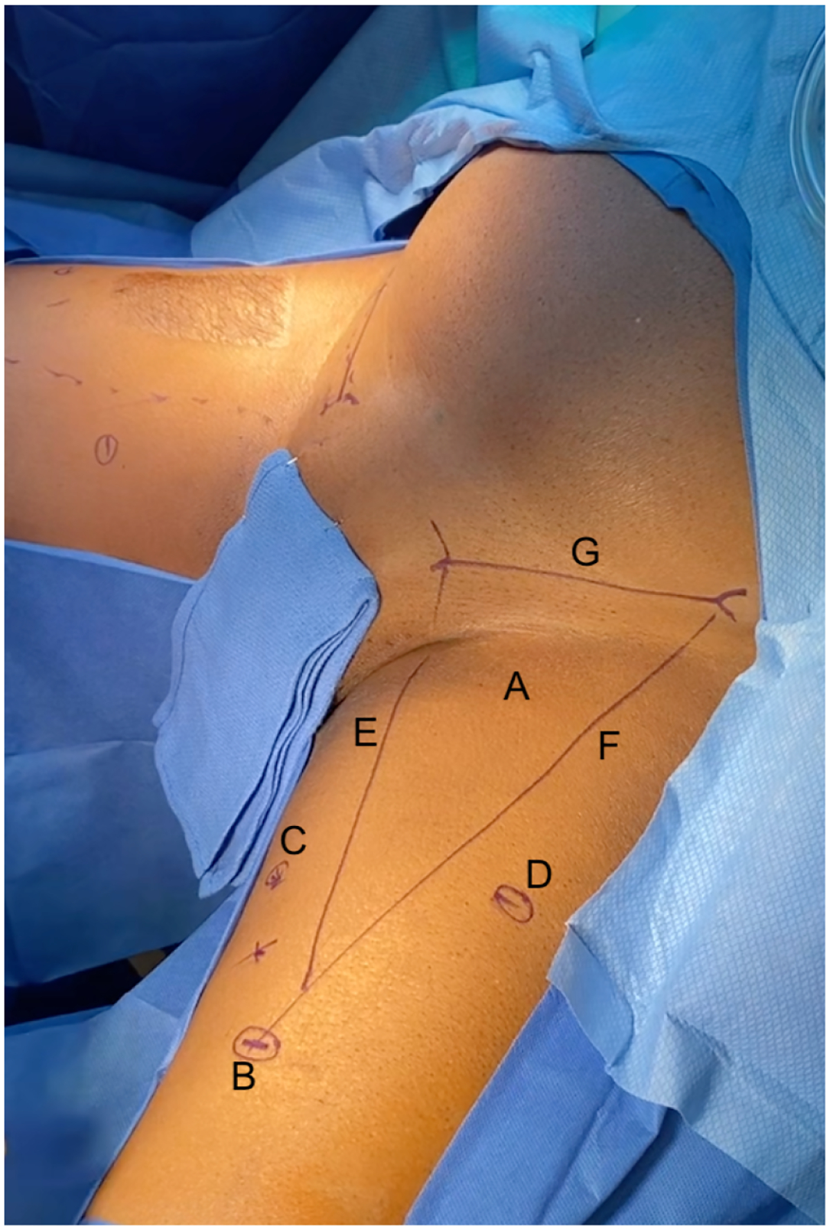 Video-endoscopic inguinal lymphadenectomy (VEIL) oncological and surgical benefits compared to open inguinal lymph node dissection (ILND).