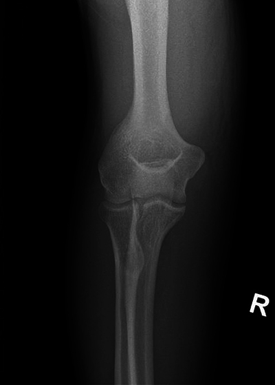 A Case of a Mirror Image Artifact in the Forearm.