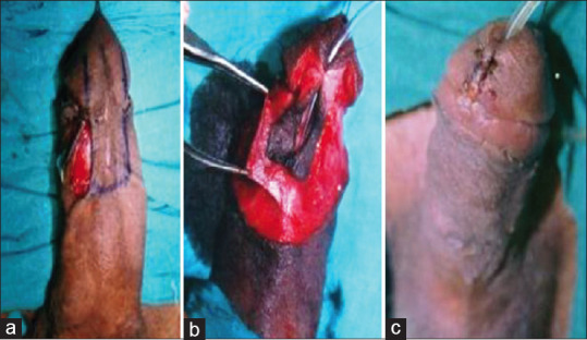 Retrospective Comparative Study between Duplay and Koff Methods in Repair of Distal Hypospadias.
