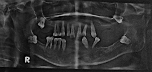 Negligence of gingival overgrowth leading to loss of entire dentition.